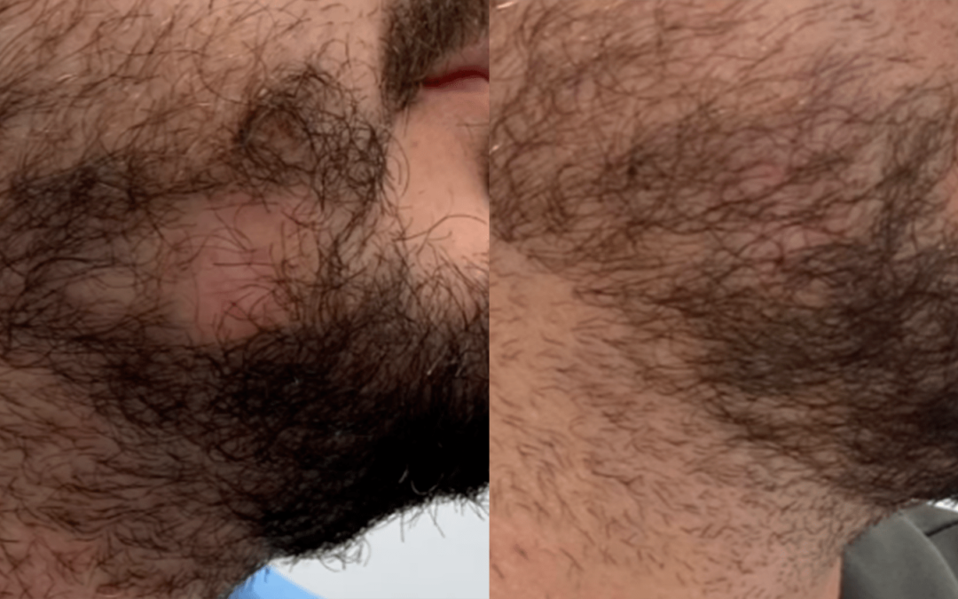 Trasplante en barba